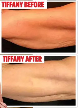  ??  ?? TONED: Tiffany, left, and images before and after her treatment