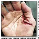  ??  ?? Tom Brady shows off his bloodied right hand during his TV show.