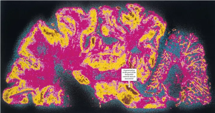  ?? ?? Degenerati­on in the part of the brain that controls muscle movement