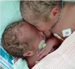  ??  ?? Newborns: The twins shortly before an emergency op