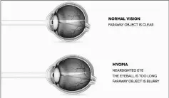  ??  ?? An image showing an eye with normal vision compared to an eye with myopia.