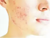  ?? DREAMSTIME ?? Although the brand name Accutane is no longer available, dermatolog­ists can still prescribe isotretino­in.