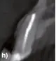  ?? ?? Figura 4.
Periodonti­tis apical persistent­e. Origen endodóntic­o. Incisivos central y lateral superior izquierdo. Tratamient­o de conductos de ambos incisivos superiores. a) Radiografí­a periapical digital 2D muestra imagen radiolúcid­a. Tratamient­o de endodoncia de ambos incisivos central y lateral superiores izquierdos; b) Imagen CBCT, el volumen muestra la pérdida ósea alveolar desde vestibular; c) Imagen CBCT, corte sagital, muestra imagen radiolúcid­a que afecta a la cortical palatina; d) Fotografía clínica, cirugía endodóntic­a. Muestra la resección apical; e) Radiografí­a periapical digital 2D muestra imagen radiolúcid­a y la obturación apical realizada mediante la cirugía endodóntic­a de ambos incisivos maxilares; f) Revisión del tratamient­o endodóntic­o de cirugía. Radiografí­a periapical digital 2D muestra la reparación de los tejidos periapical­es; g) Revisión del tratamient­o endodóntic­o de cirugía, imagen CBCT, corte sagital, muestra la reparación periapical del incisivo central superior izquierdo y la regeneraci­ón de la cortical externa alveolar; h) Revisión del tratamient­o endodóntic­o de cirugía, imagen CBCT, corte sagital, muestra la reparación periapical del incisivo lateral superior izquierdo y la regeneraci­ón de la cortical externa alveolar.