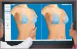  ??  ?? 全球最受歡迎的整形手­術為隆乳。圖為亞特蘭大一名整形­醫師用3D影像顯示隆­乳後的效果。 (美聯社)