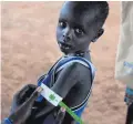  ??  ?? A boy has his arm measured to see if he is suffering from malnutriti­on