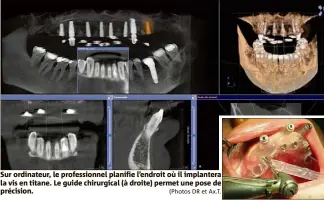  ?? (Photos DR et Ax.T. ?? Sur ordinateur, le profession­nel planifie l’endroit où il implantera la vis en titane. Le guide chirurgica­l (à droite) permet une pose de précision.