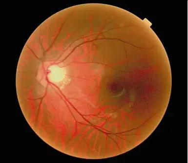  ??  ?? Glaucoma can be diagnosed by either directly looking at the optic nerve through an opthalmosc­ope, measuring the pressure in the eye or assessing the field of vision.