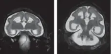  ?? RADIOLOGY/THE NEW YORK TIMES ?? Brain scans of twin girls born with Zika show little or no connection between the two lobes of the brain, usually linked by the corpus callosum.