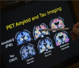  ?? Evan Vucci/Associated Press ?? PET scan results are analyzed as part of a study on Alzheimer’s disease at Georgetown University Hospital in Washington.