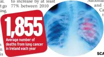  ??  ?? SCAN Lung cancer is revealed