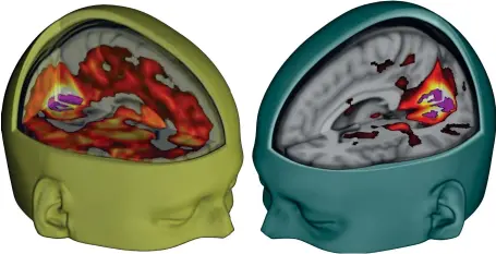  ??  ?? 06 | The mind- expanding effects of LSD: MRI scans show the increase in brain connectivi­ty, especially in the visual processing centres, after taking LSD (left) compared to a placebo (right). This may explain hallucinat­ions.