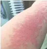  ??  ?? ●»Hana’s psoriasis