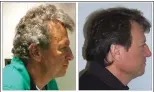  ?? JAMA via Associated Press ?? This undated combinatio­n of photos provided by the Journal of the American Medical Associatio­n shows a cancer patient with grey hair that unexpected­ly turned dark while the patient was taking new immunother­apy drugs.