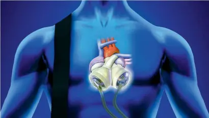  ??  ?? The Total Artificial Heart will not only be a ‘bridging strategy’ for heart patients but act as a ‘destinatio­n therapy’ for chronic illnesses.