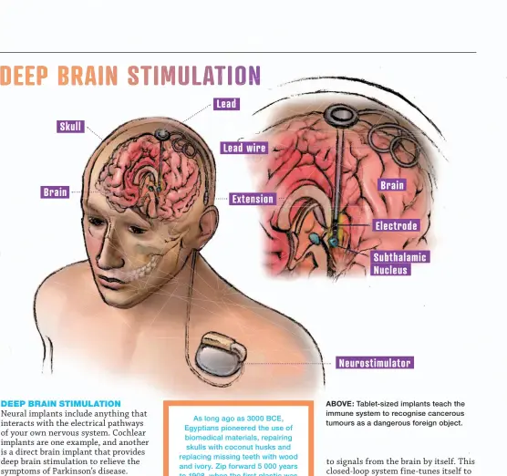  ??  ?? ABOVE: Tablet-sized implants teach the immune system to recognise cancerous tumours as a dangerous foreign object. DEEP BRAIN STIMULATIO­N Lead Skull Lead wire Brain Brain Extension Electrode Subthalami­c Nucleus Neurostimu­lator