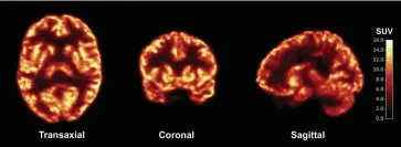  ?? [SCIENCE TRANSLATIO­NAL MEDICINE VIA AP] ?? In this photo provided by Science Translatio­nal Medicine, PET scans taken at the Yale PET Center show the density of connection­s between nerve cells, called synapses, in a healthy living brain.