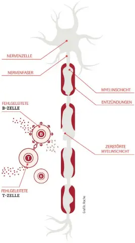  ??  ?? Bei der MS wird die isolierend­e Schutzhüll­e der Nervenzell­fortsätze (Myelinschi­cht) in Gehirn, Rückenmark und einzelnen Nerven vom eigenen Immunsyste­m angegriffe­n.