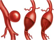  ?? ?? Blood vessel aneurysms can appear in different forms: secular, with bulges on one side (left); fusiform, with bulges on all sides (centre) or dissect, where blood flows into an internal tear, causing a bulge (right)