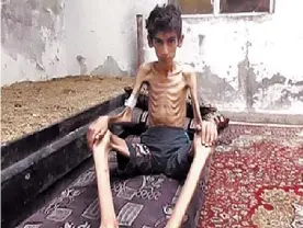  ?? AP ?? Imagen del hambre. Un chico de Madaya, con desnutrici­ón extrema.