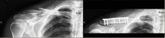  ??  ?? Sur les deux images de gauche, on voit bien la fracture. Ces patients ont été opérés, on voit les plaques à droite. Ci-dessous, le patient n’a pas souhaité être opéré et a porté des anneaux. Certes la fracture s’est consolidée mais un cal résiduel s’est formé. (Photos Ax.T. et DR)