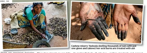  ??  ?? Cashew misery: Yashoda shelling thousands of nuts with just one glove and (above) her acid burns are treated with ash