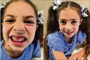  ?? CONTRIBUTE­D ?? When 6-year-old Rosie Weishar’s two permanent teeth erupted, they crowded her baby teeth. But her mom had to wait weeks to take her to the dentist, because offices were closed to all but emergency dental work.