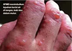  ?? ?? HFMD menimbulka­n lepuhan berisi air di tangan, kaki dan dalam mulut.