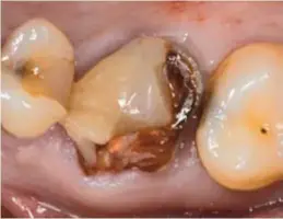  ??  ?? Figura 3.1.- Primer molar superior a extraer.