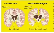  ??  ?? A sinistra, un cervello sano. A destra, le alterazion­i indotte dalla malattia di Huntington in fase avanzata. La conformazi­one dei ventricoli “prende” lo spazio normalment­e occupato dal liquido cefalorach­idiano, che protegge e mantiene sano il...