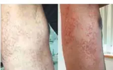  ?? Courtesy: University Hospital Sharjah ?? Top: Comparison of skin lesions caused during the ketogenic diet and 5 days after discontinu­ation of the diet.