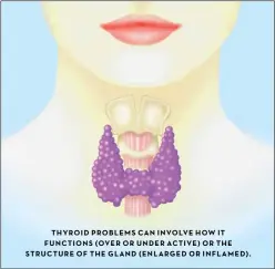  ??  ?? THYROID PROBLEMS CAN INVOLVE HOW IT FUNCTIONS OVER OR UNDER ACTIVE OR THE STRUCTURE OF THE GLAND ENLARGED OR INFLAMED