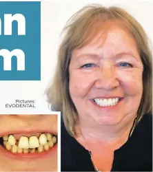  ?? Pictures: EVODENTAL ?? Before and after: Eat as you wish and smile confidentl­y
