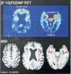  ?? Jeff Siner / Tribune News Service ?? Signs of CTE are evident in the brain scans of NFL Hall of Famer Joe DeLamielle­ure, 66, a lineman for 13 seasons with the Bills and Browns in the 1970s and ’80s.