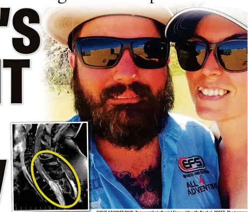  ??  ?? FIGHT AGAINST PAIN: Toowoomba’s Daniel Eiser with wife Rachel. INSET: The tumour on his spine. PHOTO: CONTRIBUTE­D