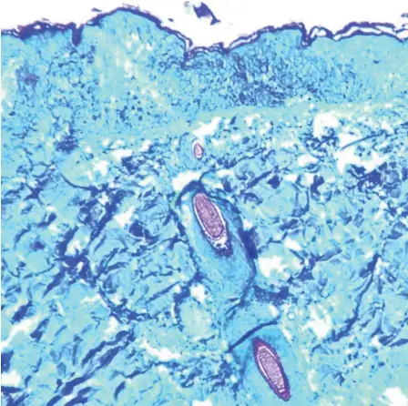  ?? ?? Imagen de tejido de la epidermis afectado por la viruela símica