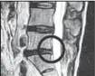  ??  ?? AFTER MRI images of herniated disk before and after our treatment.