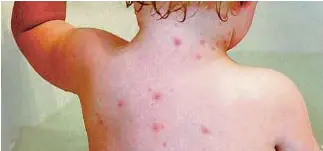  ?? PICTURE FROM: WWW.DAILYDOT.COM ?? Chicken pox is also known as varicella and is very contagious.