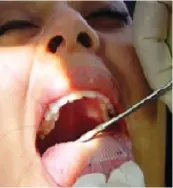  ??  ?? Lysander Lanuza a woman from the US undergoes tongue-patch surgery