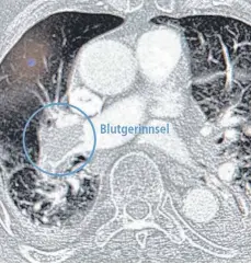  ?? FOTO: ADK GMBH ?? Das Bild zeigt eine CT-Aufnahme eines Blutgerinn­sels in der Lunge. Durch die Einführung zweier innovative­r Behandlung­sverfahren wird die Therapie von Lungenembo­lien im Alb-Donau Klinikum verbessert.