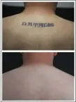  ?? PAUL FRIEDMAN MD VIA THE ASSOCIATED PRESS ?? This combinatio­n of undated photos provided by Dr. Paul Friedman in July 2019 shows the back of patient Ryan Tucker before and after a series of laser tattoo removal procedures in Houston.