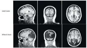  ?? WESTERN UNIVERSITY BRAIN AND MIND INSTITUTE ?? The slides show Milena Canning’s brain compared to the brain of Jody Culham, a neuropsych­ologist whose team at Western University’s Brain and Mind Institute have published a paper on Milena’s condition.