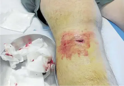  ?? Fotos: cedidas ?? La herida en la pierna del cazador Jesús Mangado.