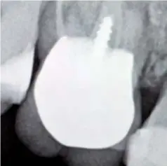  ??  ?? Figura 2.1.- Imagen RX del primer molar superior a extraer. La mayoría de estos casos se dan en piezas endodoncia­das y con al menos una raíz anquilosad­a.