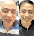  ?? ?? Clown brows on the left and repaired brows after nearly a year of pigmentati­on removal