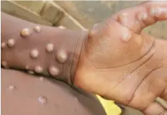  ?? ?? Blisters: Monkeypox rashes develop into pustules