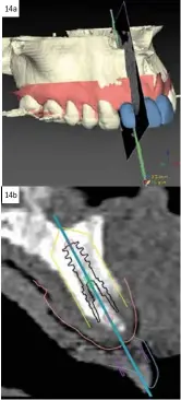  ??  ?? 14a 14b 12. Cirugía implantari­a guiada por ordenador con enfoque “sin colgajo”: vista preoperato­ria. 13a y 13b. Cirugía implantari­a guiada por ordenador con enfoque “sin colgajo”: a la izquierda se puede ver la plantilla quirúrgica y a la derecha la versión clínica postoperat­oria. 14a y 14b. Software de planificac­ión para cirugía de implantes guiada por ordenador.