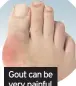  ??  ?? Gout can be very painful