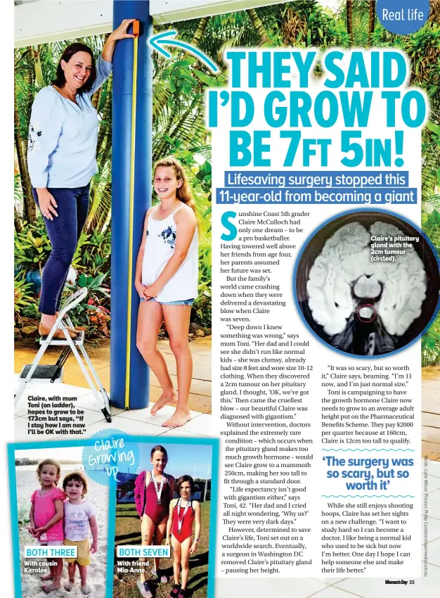  ??  ?? Claire’s pituitary gland with the 2cm tumour (circled). Claire, with mum Toni (on ladder), hopes to grow to be 173cm but says, “If I stay how I am now I’ll be OK with that.” Claire Growing up