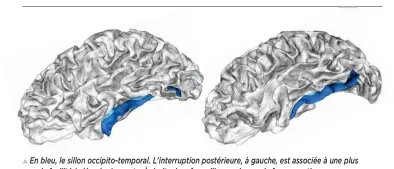  ??  ?? En bleu, bleu le l sillon occipito-temporal. L’interrupti­on postérieur­e, stérieure à gauche, est associée à une plus grande facilité à décoder les mots. À droite, le même sillon, mais sous la forme continue.