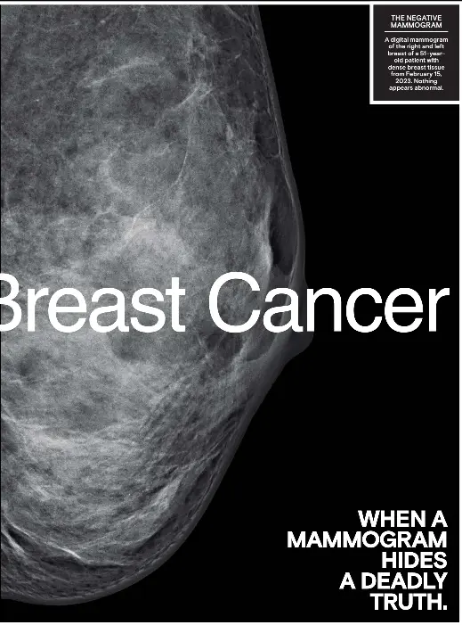  ?? ?? THE NEGATIVE MAMMOGRAM A digital mammogram of the right and left breast of a 51-yearold patient with dense breast tissue from February 15, 2023. Nothing appears abnormal.